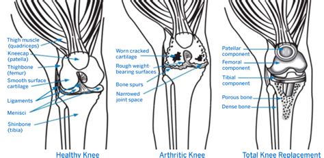 anatomy of total knee replacement