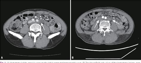 Figure 1 From Traumatic Abdominal Wall Hernia With Hemoperitoneum