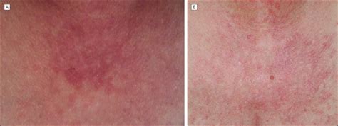 Successful Treatment Of Subacute Lupus Erythematosus With Ustekinumab Dermatology Jama