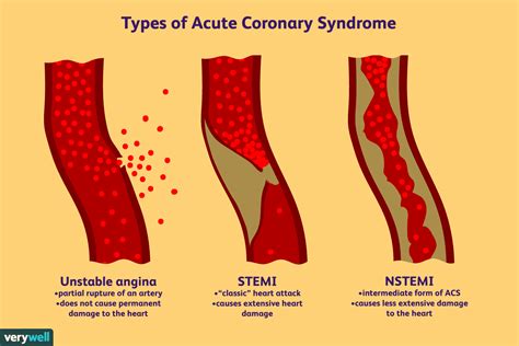 What Is Coronary Artery Syndrome Pelajaran