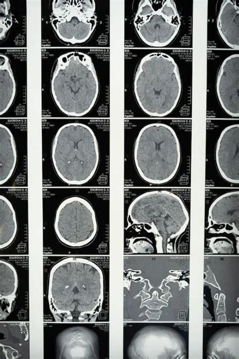 Brain Imaging Techniques 3 Types And Pros Cons