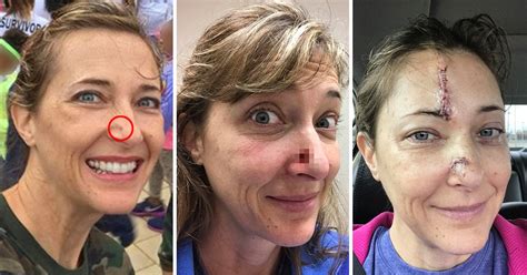 Woman Who Thought Cancer Was Just A Spot Had Half Her Nose Scooped Out