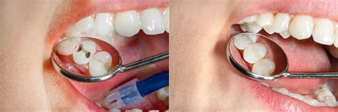 A Complete Guide To Rotten Teeth Causes And Treatment Options Victory Plaza Dental Group