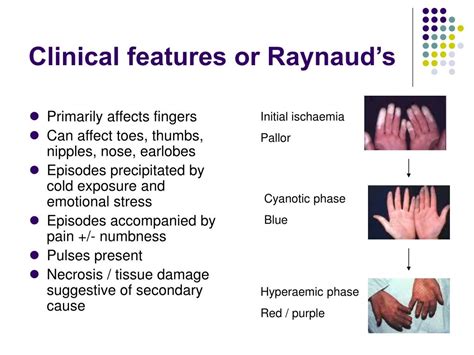 Ppt Raynauds Syndrome Vasospastic And Occlusive Arterial Disease My Xxx Hot Girl