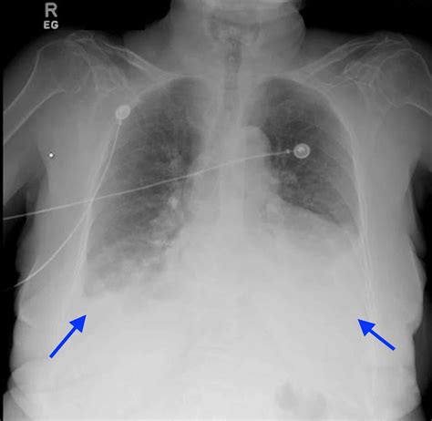 Chest X Ray Shows Complete Resolution Of Bilateral Pleural Effusion Images
