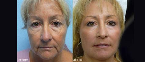 Top Cosmetic Surgeon In Temecula Oneil Skin And Lipo Medical Center