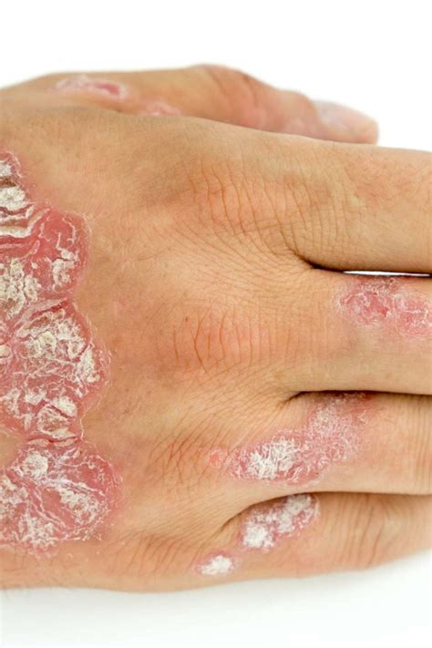 Types Of Mild Psoriasis Treatment Symptoms And Pictures