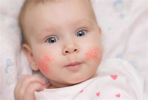 أسباب حساسية الجلد عند الأطفال حديثي الولادة طلاب نت