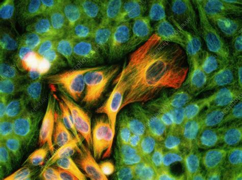 Immunofluorescent Lm Of Melanoma Cancer Cells Stock Image M1320333