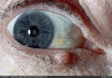 Stock Image Close Up Of A Papilloma On The Lower Eyelid Of A Persons