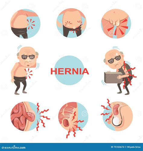 Stomach Hernia Symptoms In Men