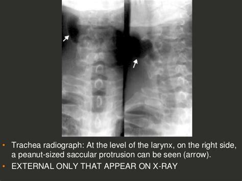 Full Story Larynx Imaging Ct Mri Dr Ahmed Esawy