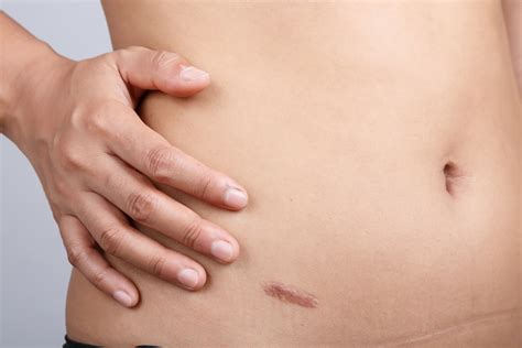 Laparoscopic Appendectomy Belly Button Scars