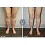 Restless Leg Syndrome Treatment  The Vein Institute At SSA
