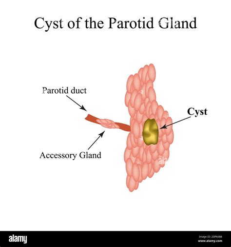 Parotid Salivary Gland Cyst The Structure Of The Parotid Salivary