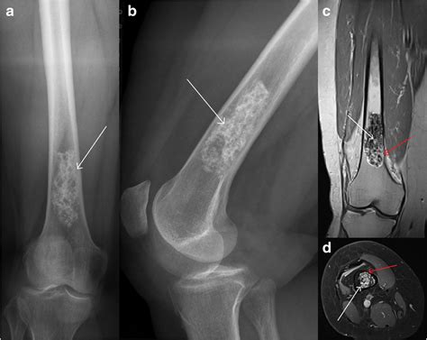 Conservative Treatment At The Distal Femur Typical Chondroid Matrix