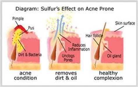 Efficacy of tetracyclines in the treatment of acne vulgaris: POWERFULL DE LA CRUZ 10% SCHWEFEL SALBE CREME + FREI ...