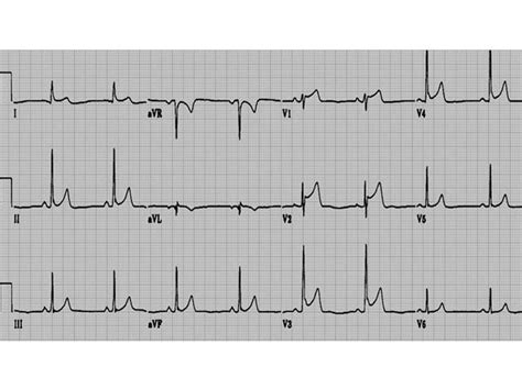 Jun 30, 2017 · a presença de dor torácica deve ser caracterizada como aguda ou pleurítica. Desafios de ECG | Descomplicando ECG