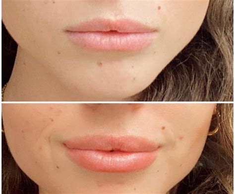 What Is The Botox Lip Flip Treatment Benefits And Side Effects