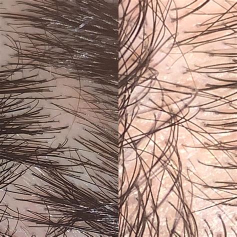 Are You Experiencing Heavy Hair Shedding On The Scalp Updates And Info That You Might Want