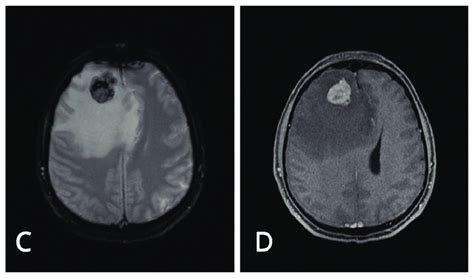 Preoperative Brain Mri Images Axial View T1 Weighed Image T1wi A