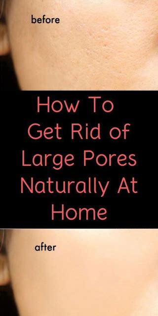 How To Get Rid Of Large Pores Naturally At Home Healthy Deadline