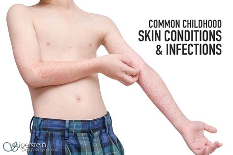 A Handy Guide To Common Childhood Viral Skin Conditions
