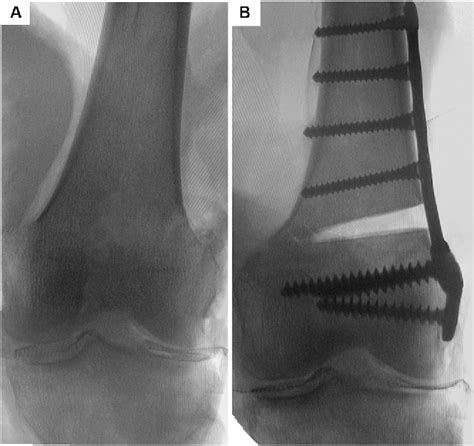 Figure 2 From The Effect Of Lateral Opening Wedge Distal Femoral Varus