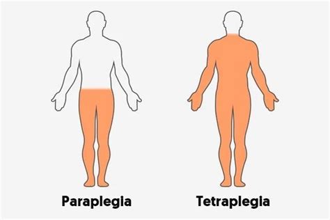Tetraplegia Cause Symptoms Treatment Mobile Physio
