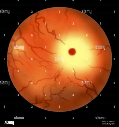 Retina Ocular En La Enfermedad De Tay Sachs Fotografías E Imágenes De