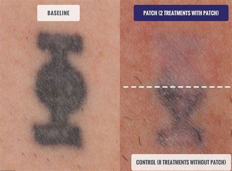 Top 56 Images About Tattoo After Laser Removal Just Updated Ink