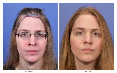 Transgender Before And After Photos Gallery Portland Oregon Gabel Center