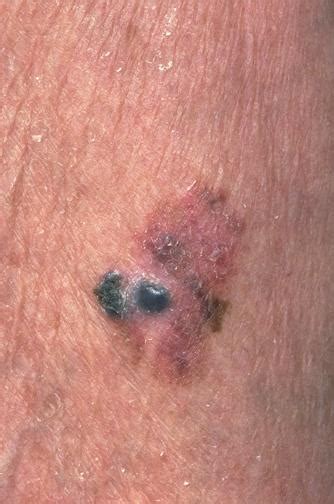Describes the tumor's thickness, or how deep it has grown into the skin. Metastatic Malignant Melanoma - MEDizzy Journal