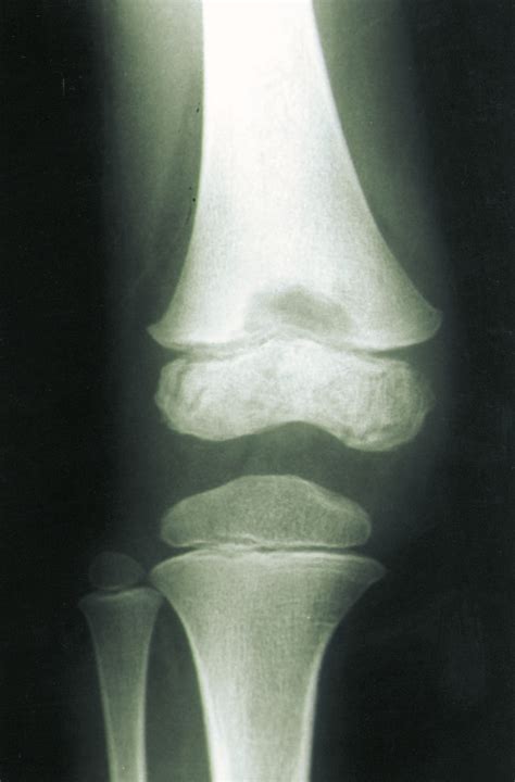 Case 2 Right Knee The Ap A And Lateral B Radiographs 3 Weeks
