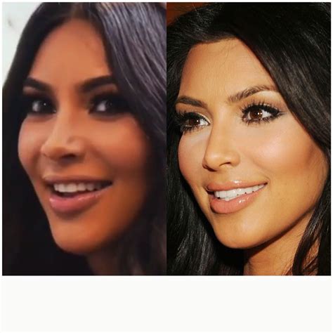 Kim Kardashian Fillers And Nose Job Before And After Nose Job