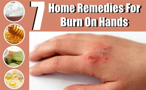 7 Simple Home Remedies For Burns Home Remedies For Burns Burn Remedy