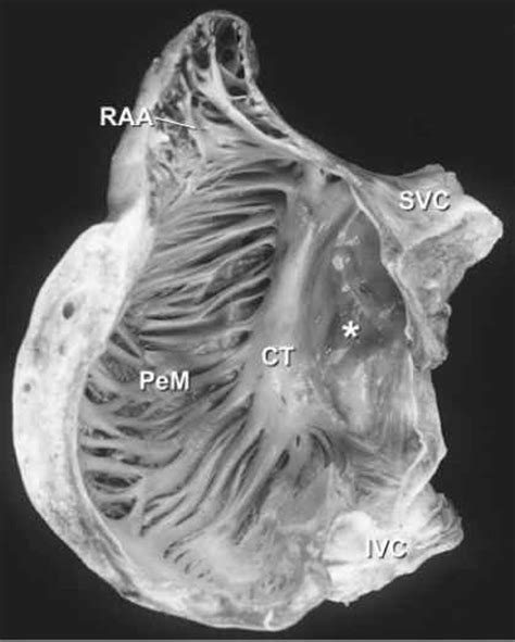 Enlarged Aortic Root Left Atrial Enlargement Sigmoid Septum Coronary