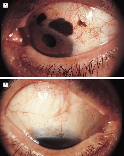 Topical Mitomycin Chemotherapy For Conjunctival Malignant Melanoma And