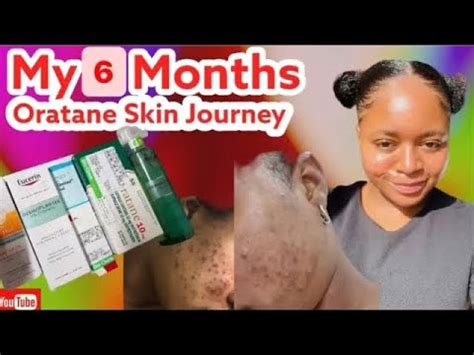 My Oratane Accutane Skin Journey Before After Pictures Is It Worth It YouTube