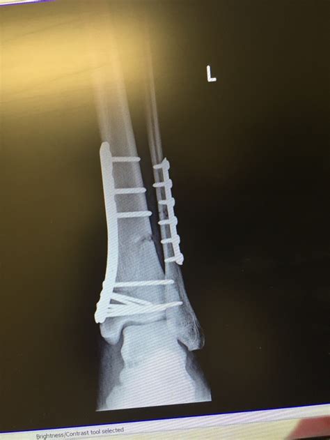 Compound fracture of tibia and fibula recovery