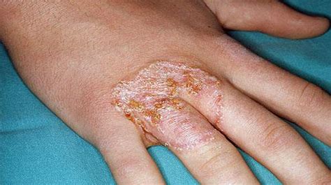 Hand Fungus Types Causes And Pictures Health Digest