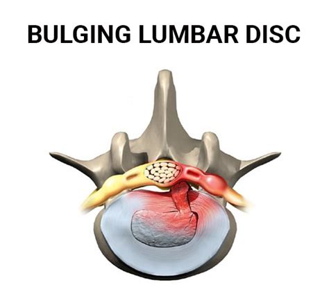 Lumbar Bulging Disc Nj And Nyc Bulging Disc Treatments