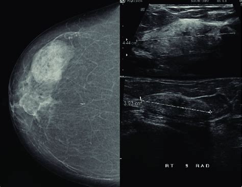 A 78 Year Old Woman With Diffuse Palpable Lump In The Right Breast