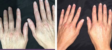 Hand Rejuvenation Before And After Kingsway Dermatology