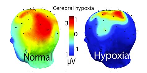 Post Covid Cerebral Hypoxia — Covidcaregroup