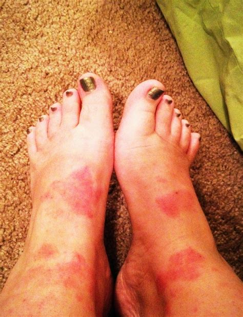 Skin Rash On Foot Pictures Photos