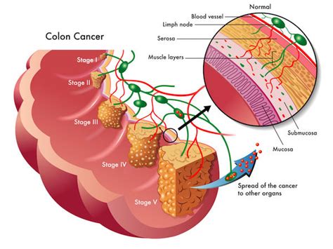 Colorectal Cancer Causes Symptoms And Treatment Clicks Health Hub