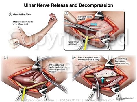 Ulnar Nerve Decompression Legal Graphicworks