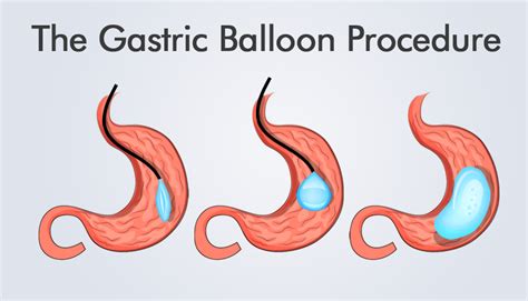 What You Need To Know About Gastric Balloon Procedures Obesityhelp