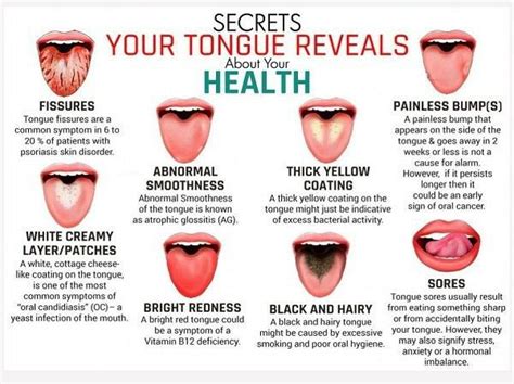 If Anyone Else Out There Has Geographic Tongue When You Have Flare